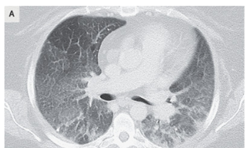 喫煙関連特発性間質性肺炎(剥離性間質性肺炎、DIP:desquamative interstitial pneumonia):たばこを吸うとなる間質性肺炎のアイキャッチ画像