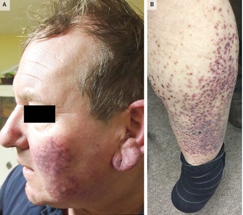 慢性リンパ性白血病(CLL)に続発する1型クリオグロブリン血症血管炎のアイキャッチ画像
