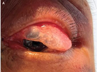 外傷性眼窩気腫症（転倒により複視と眼瞼浮腫出現）のアイキャッチ画像