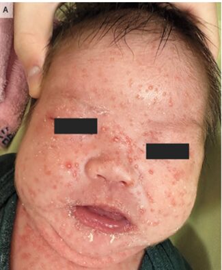 突然膿胞性（生後8日の男児に突然出現）のアイキャッチ画像