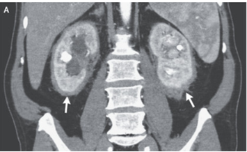 Erdheim–Chester disease：エルトハイム・チェスター病（腎周囲に認めた非ランゲルハンス細胞組織球症）のアイキャッチ画像