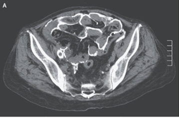 被膜性腹膜硬化症（肥厚した壁側腹膜）のアイキャッチ画像