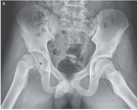 大腿骨頭すべり症（10代に最も一般的な股関節疾患）のアイキャッチ画像