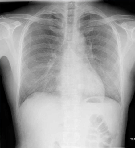 薬剤性肺障害の胸部レントゲン（X-p）写真のアイキャッチ画像