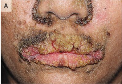 印環細胞癌（卵巣転移を伴う胃腺癌：クルーケンベルグ腫瘍としても知られる）のアイキャッチ画像