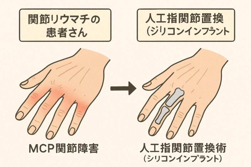関節リウマチ患者さんのMCP関節障害に対しては人工指関節置換術(シリコンインプラント)を検討のアイキャッチ画像