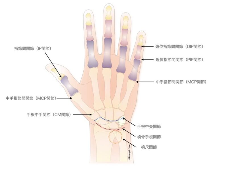 手関節障害に対しては部分固定術およびSauve-Kapamdji(ソーベ・カパンジー)手術を考慮のアイキャッチ画像