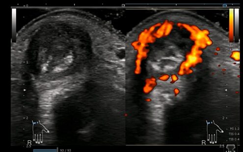 非専門医でも診る必要のあるRA③ 関節エコーと病変評価のアイキャッチ画像
