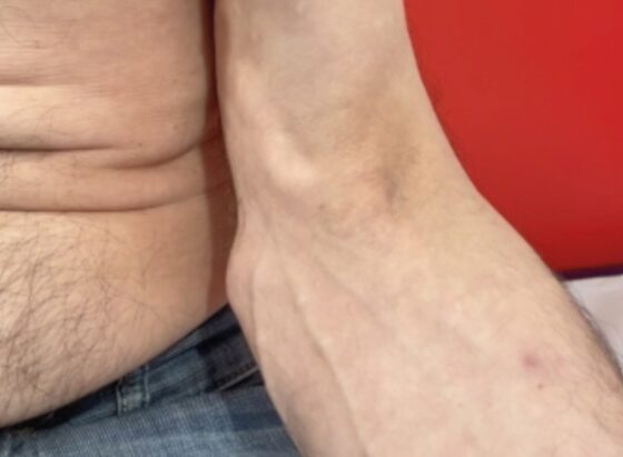 上腕ロコモーター徴候:重度の弁膜症に伴う幅広い脈圧と拡張期の流れの逆転により、大動脈弁逆流の患者に見られますのアイキャッチ画像