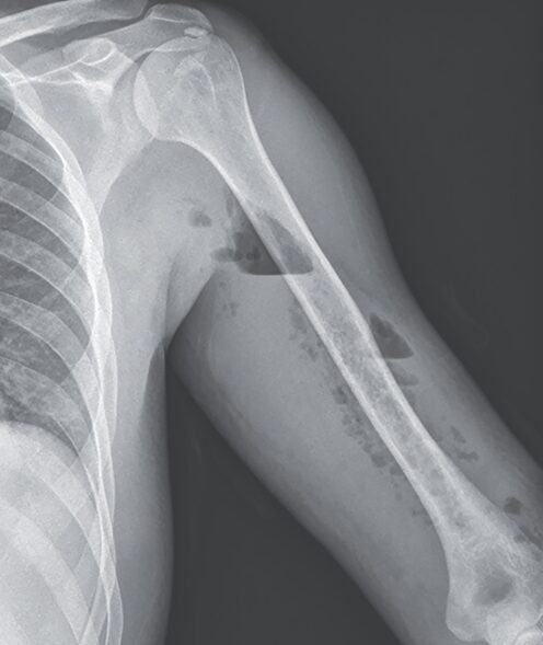 壊死性筋膜炎:レントゲンで分かる症例のアイキャッチ画像