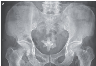 ジャックストーン結石:膀胱内シュウ酸Ca二水和物結石のアイキャッチ画像