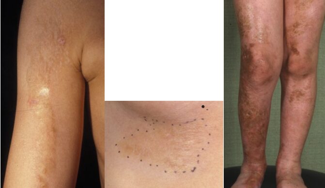 全身性強皮症と診断するために除外する疾患②　汎発型限局性強皮症のアイキャッチ画像