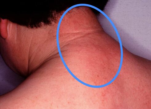 全身性強皮症と診断するために除外する疾患④　糖尿病性浮腫性硬化症のアイキャッチ画像