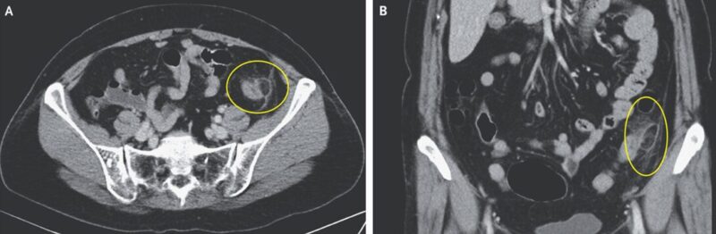 腹膜垂炎の一例のアイキャッチ画像
