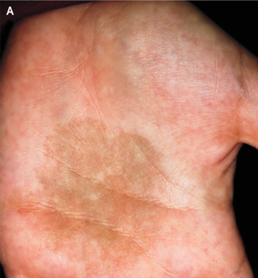 黒白癬:てのひらの茶色のしみ(斑点)。皮膚顕微鏡検査で色素性棘。のアイキャッチ画像