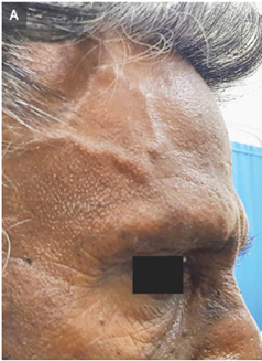 巨細胞性動脈炎の一例:側頭動脈肥厚著明例です。のアイキャッチ画像