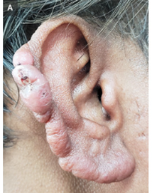 ハンセン病：らい菌複合体によって引き起こされる皮膚と神経の慢性感染症のアイキャッチ画像