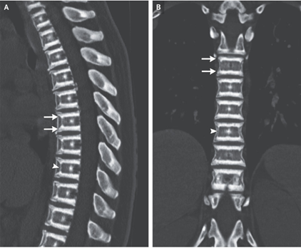 大理石骨病（指定難病326）：遺伝子CLCN7の変異のアイキャッチ画像
