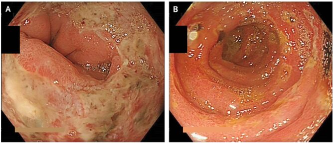ガストリノーマに起因する胃酸過剰分泌症候群(ゾリンジャー・エリソン症候群)のアイキャッチ画像