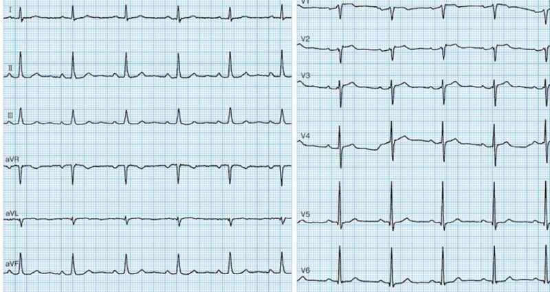 心電図の読み方2　ST上昇の定義を解説のアイキャッチ画像