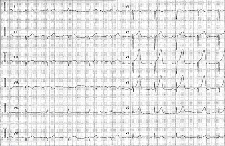 心電図の読み方1　AMI早期からのST変化を解説のアイキャッチ画像