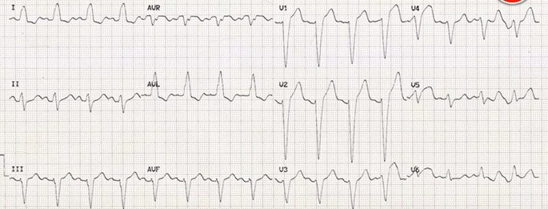 心電図の読み方11　脚ブロックの解説（左脚ブロック＋胸痛は心電図から判断してはいけない）のアイキャッチ画像