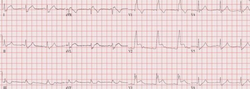 心電図の読み方13　右脚ブロック＋前壁梗塞症例のアイキャッチ画像