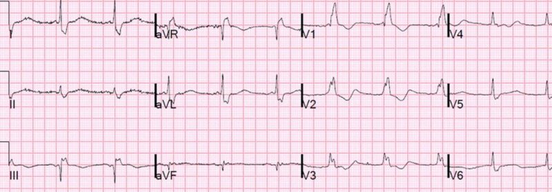 心電図の読み方14　右脚ブロック＋aVRのST上昇症例（有意所見とはとってはいけない心電図症例）のアイキャッチ画像