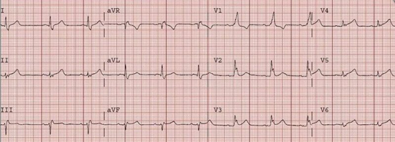 心電図の読み方15　右脚ブロック＋前壁側壁梗塞症例（V2、V3、V5、V6 ST上昇）のアイキャッチ画像