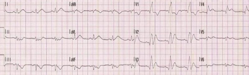 心電図の読み方16　右脚ブロック＋前壁梗塞症例のアイキャッチ画像