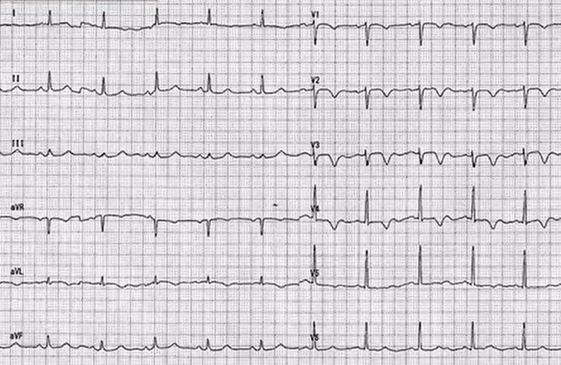 心電図の読み方17　V2-4 陰性T波の鑑別は3つ：① Recent MI（亜急性心筋梗塞）② タコつぼ心筋症 ③ Wellens症候群のアイキャッチ画像