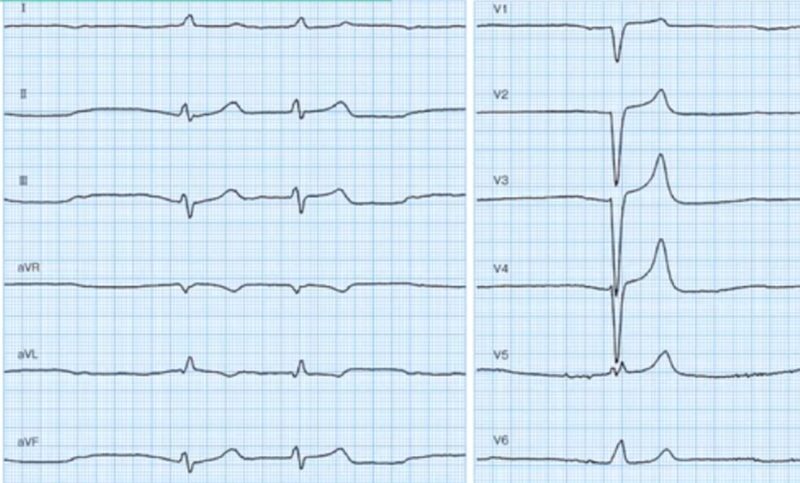 心電図の読み方18　洞不全症候群とペースメーカー埋め込み適応についての解説のアイキャッチ画像