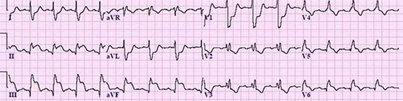 心電図の読み方12　右脚ブロック＋下壁梗塞症例のアイキャッチ画像