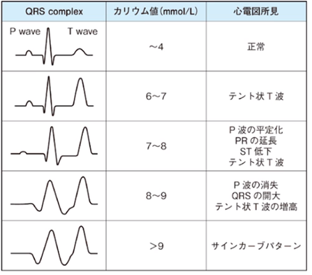 心電図の読み方19　高K血症の心電図と患者の訴えの頻度のアイキャッチ画像