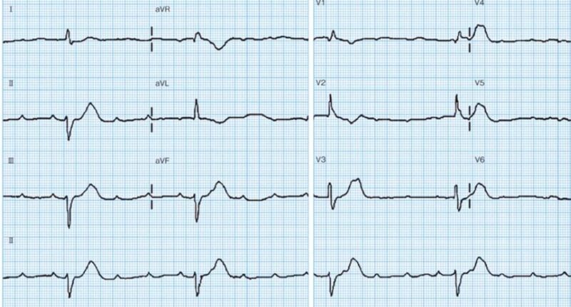 心電図の読み方21　4：1房室ブロック症例のアイキャッチ画像