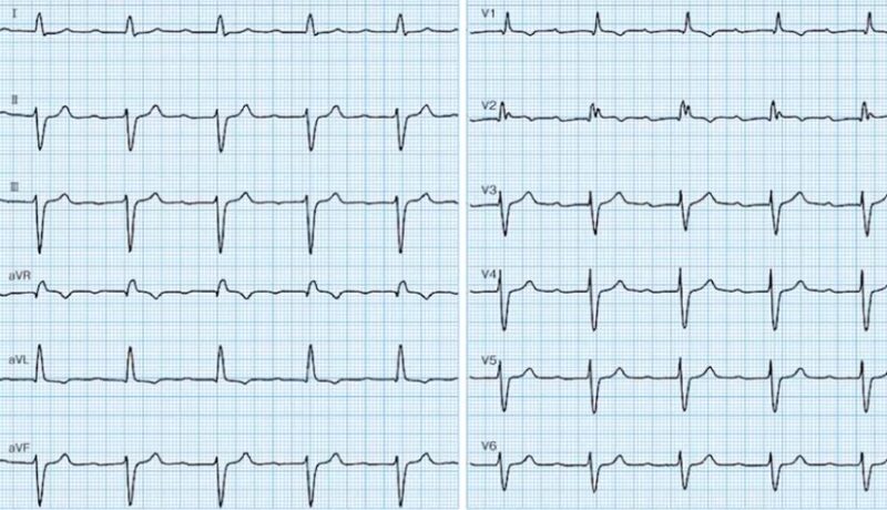 心電図の読み方23　3束ブロックによる失神の心電図の読み方を1から解説します。のアイキャッチ画像