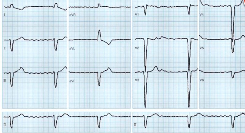 心電図の読み方24　Ⅲ度房室ブロックと診断するための心電図の読み方、やるべきことを解説します。のアイキャッチ画像