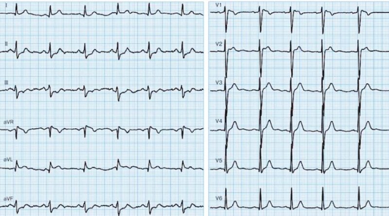 心電図の読み方25　ブルガダ（Brugada）症候群のアイキャッチ画像