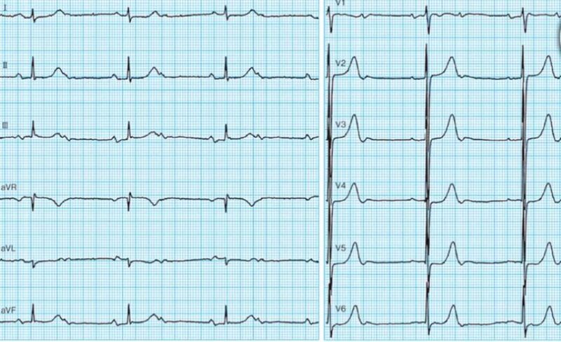 心電図の読み方20　2：1の房室ブロックの解説（「２回に1回QRSが落ちるMobitⅡ型房室ブロック」と考えるのか「２回に1回の割合でpに対して反応遅延しQRS落ちるWenchebach型AVブロック」と考えるのか）のアイキャッチ画像