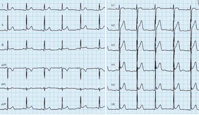 心電図の読み方26　J波症候群（早期再分極との違いを解説しています）のアイキャッチ画像
