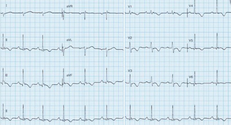 心電図の読み方28　不整脈原性右室心筋症（ARVC：arrhythmogenic right ventricular cardiomyopathy dysplasia）の症例のアイキャッチ画像