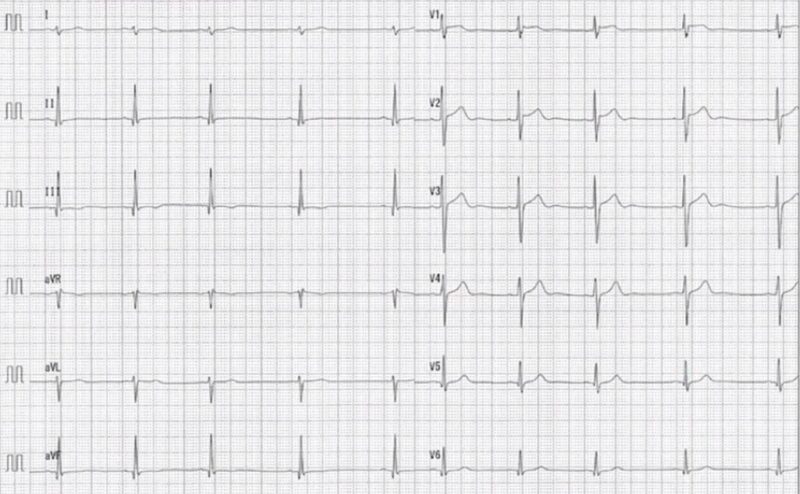 心電図の読み方27　J波症候群なのか早期再分極なのか迷う症例（早期再分極と診断し経過観察でよい症例）のアイキャッチ画像
