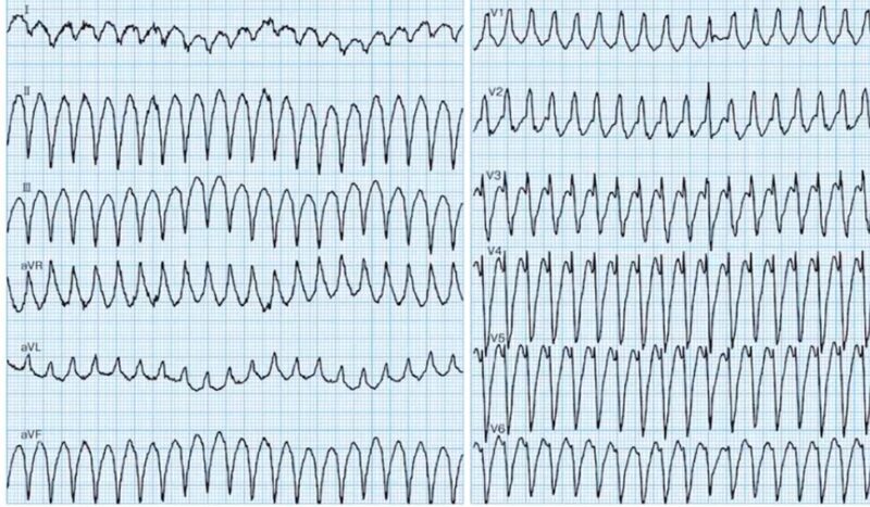 心電図の読み方30　Wide QRS頻脈を見た場合の動き方とWide QRSの鑑別、原因パターンの解説のアイキャッチ画像