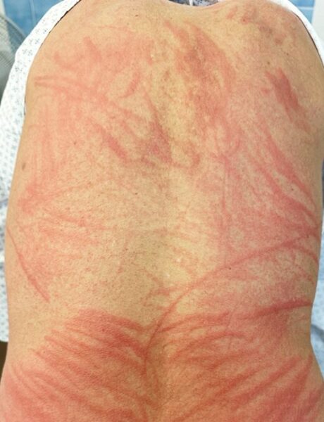 シイタケ皮膚炎：食事歴、病歴が大事になり、自然に治癒することが特徴のアイキャッチ画像