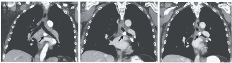 気管支結石症：石灰化物質（通常は縦隔リンパ節）が気管支に侵食のアイキャッチ画像