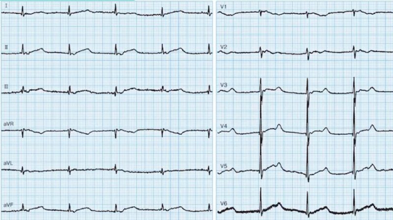 心電図の読み方29　Torsades de pointes（トルサデポアン）症例のアイキャッチ画像