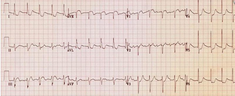 心電図の読み方4　左主幹部もしくは多枝病変のAMI症例のアイキャッチ画像