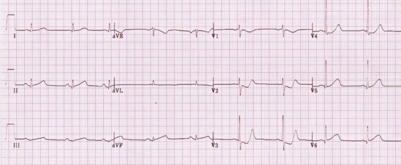 心電図の読み方6　後壁梗塞症例のアイキャッチ画像