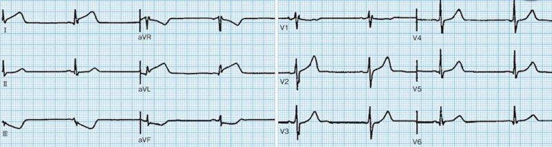 心電図の読み方3　側壁梗塞症例のアイキャッチ画像