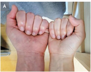 静脈胸郭出口症候群の一例：撮影条件が大事。のアイキャッチ画像